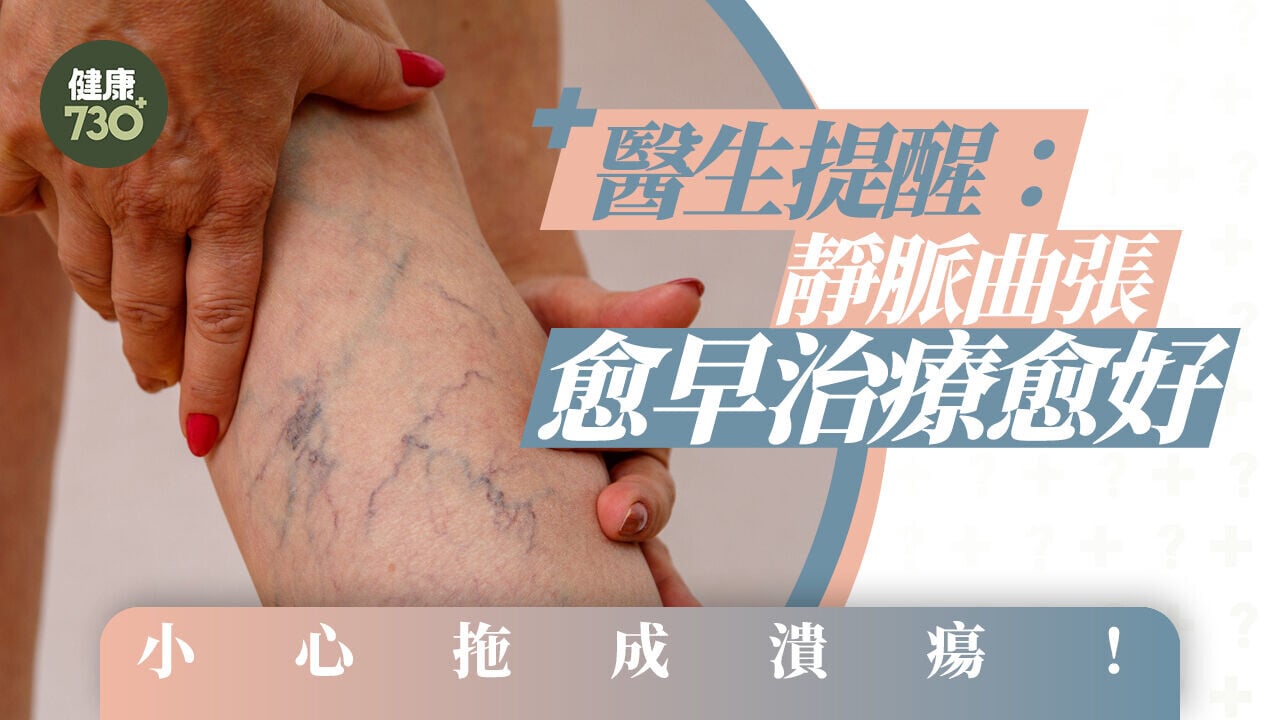 小心拖成潰瘍！醫生提醒：靜脈曲張愈早治療愈好