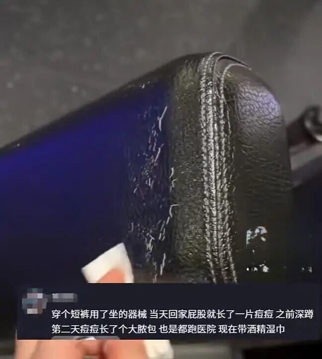運動結束後直接用手擦汗,沒想到隔天嘴唇周圍出現紅腫、搔癢症狀,就醫後確診為真菌感染
