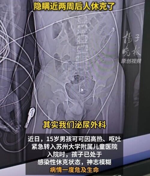少年入院時已處於感染性休克狀態,神志模糊,病情一度危及生命。(微博)