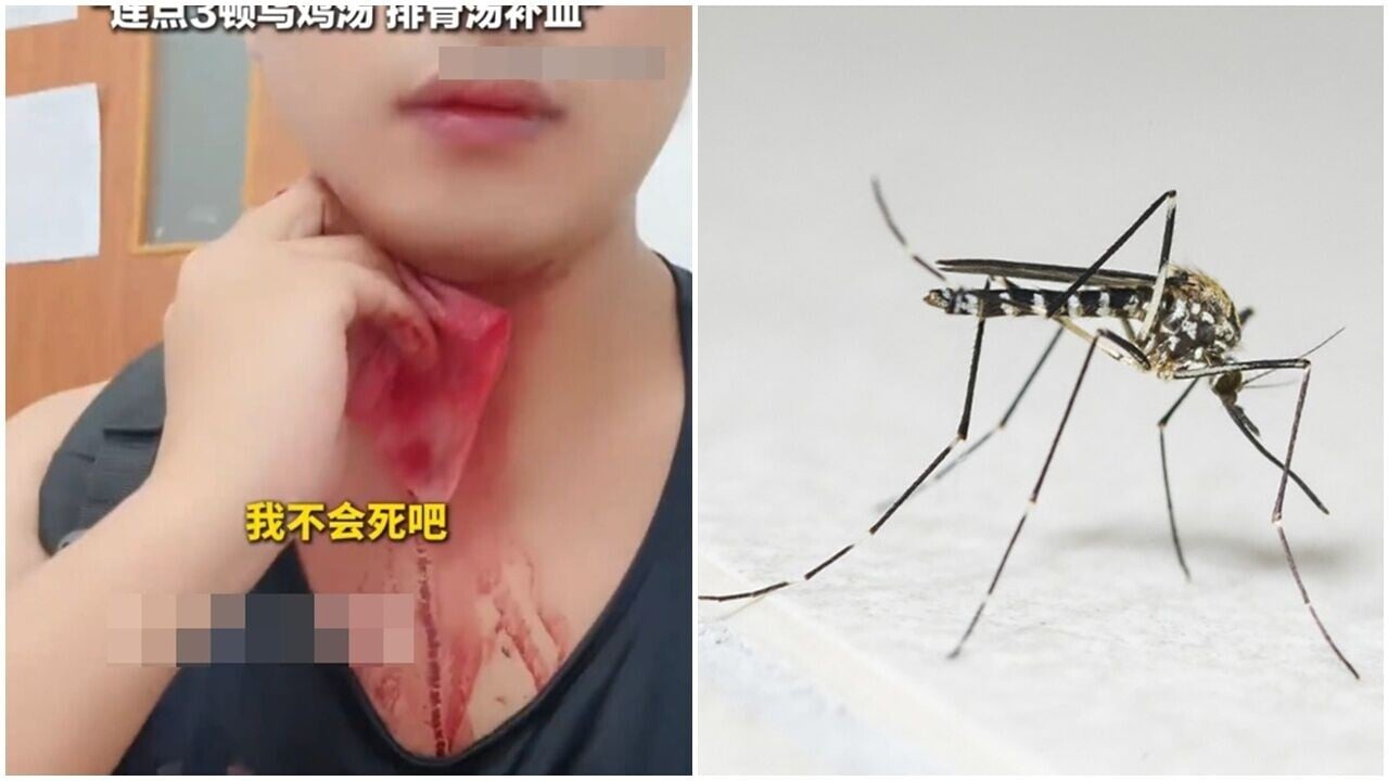 上海男被蚊咬頸，一抓竟爆血管流血不止入院。(微博)