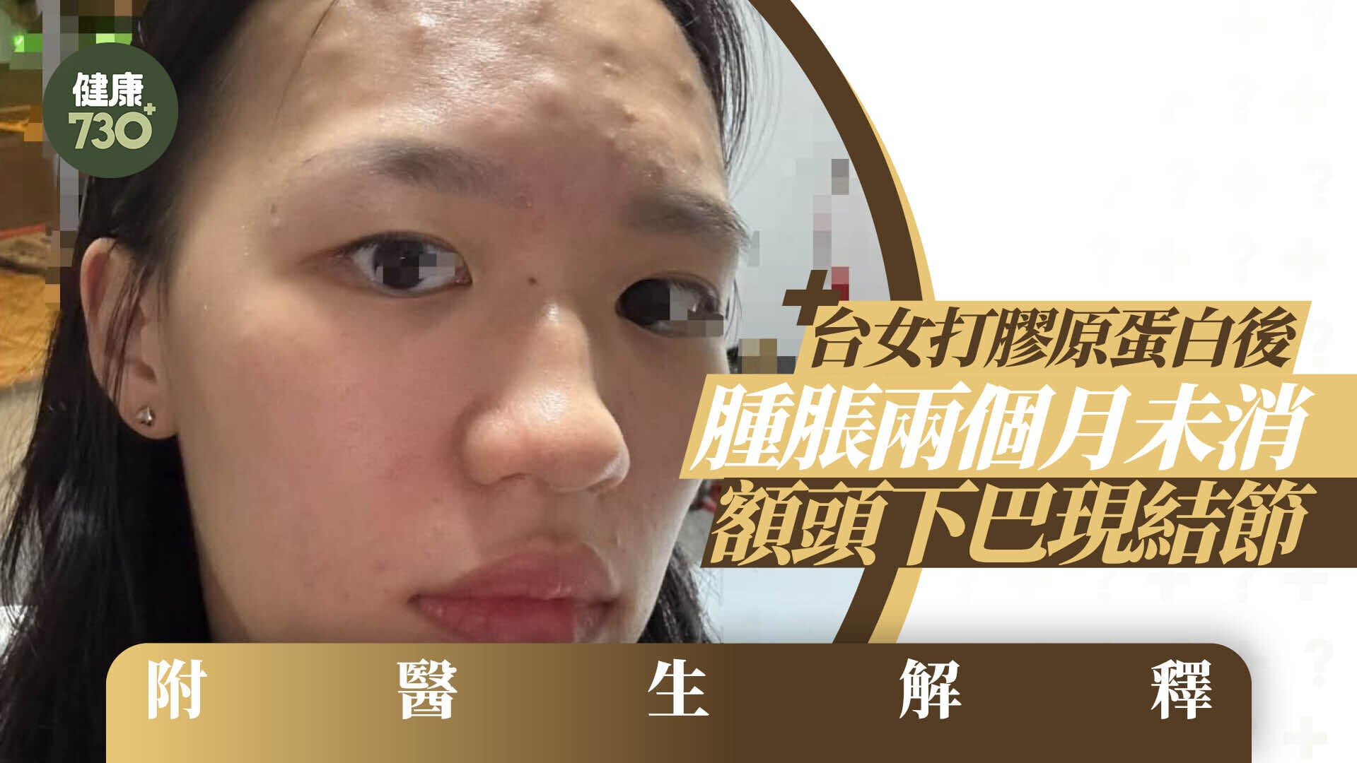 韓國醫美｜台女赴韓醫美 打膠原蛋白後腫脹兩個月未消 額頭下巴現結節 附醫生解釋(有片)
