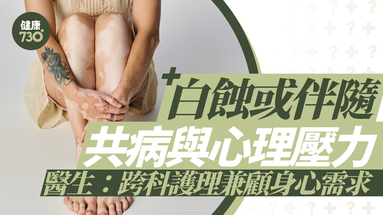 白蝕或伴隨共病與心理壓力 醫生：跨科護理兼顧身心需求