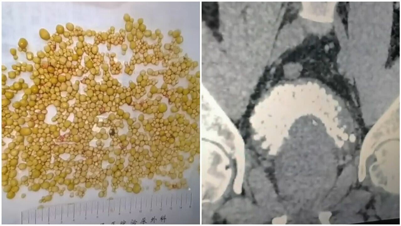 深圳七旬翁膀胱取出逾千粒結石，多到要用AI點算。(微博)