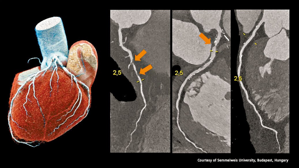 Health 3col PCCT severe stenosis 