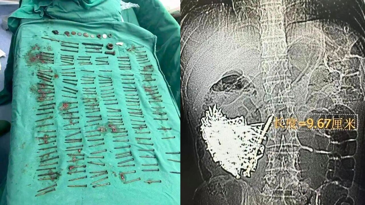 雲南漢腹痛狂嘔險死 醫生驚見180顆釘子藏胃部