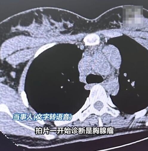 事主被發現縱隔處存有一個4.6厘米不明腫物。(微博)