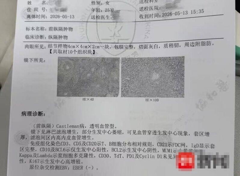 事主患上罕見的卡斯爾曼氏病(Castleman)。(微博)