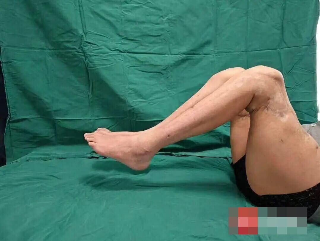 51歲男子在近20個月前,雙大腿完全離斷,兩條腿經近8小時手術被重新駁回。(微博)
