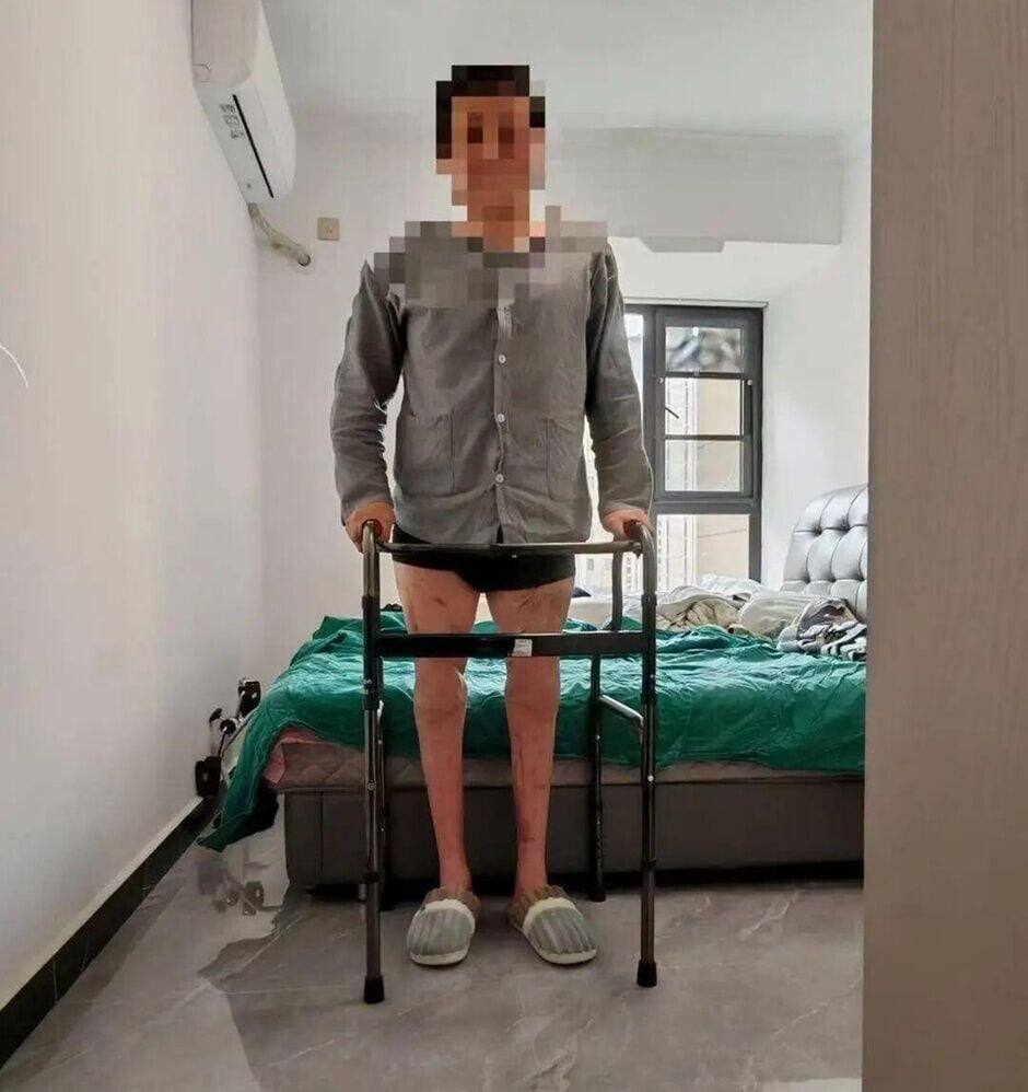 醫生指,目前病人已經可以借助助行器在室內自主行走,日常生活基本能夠自理,下肢感覺也已恢復至腳踝以上。(微博)