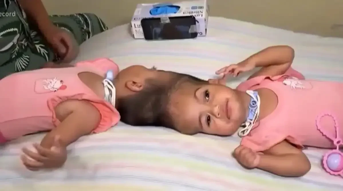 15 hour operation sisters undergone 138062352 6f4640