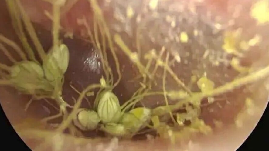 耳道藏多粒種子，竟在深處發芽生長。(微博)