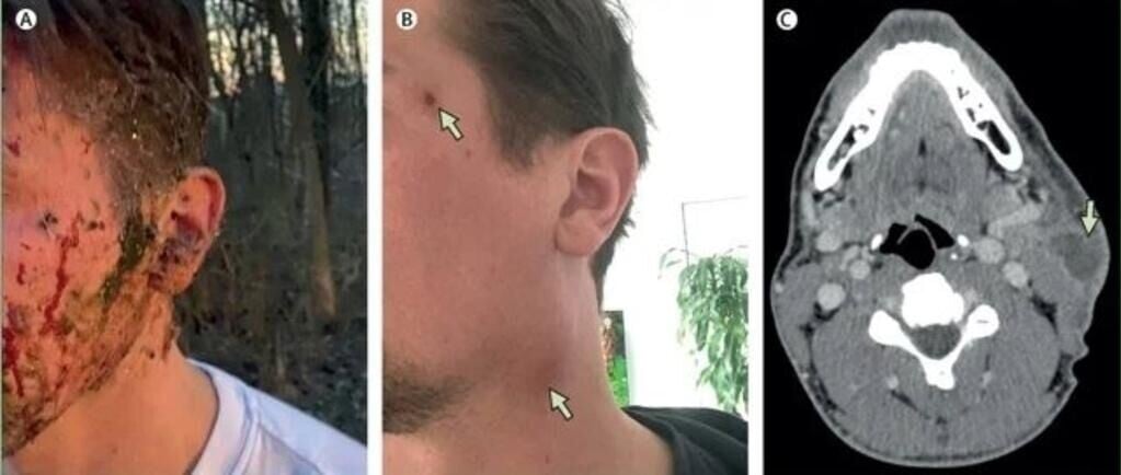 撞鹿後臉頸變異腫脹生膿 德國男怪病纏身1個月