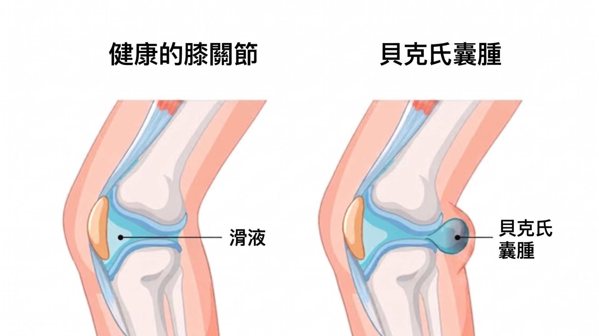 膕窩囊腫：別讓膝頭背負「痛袋」