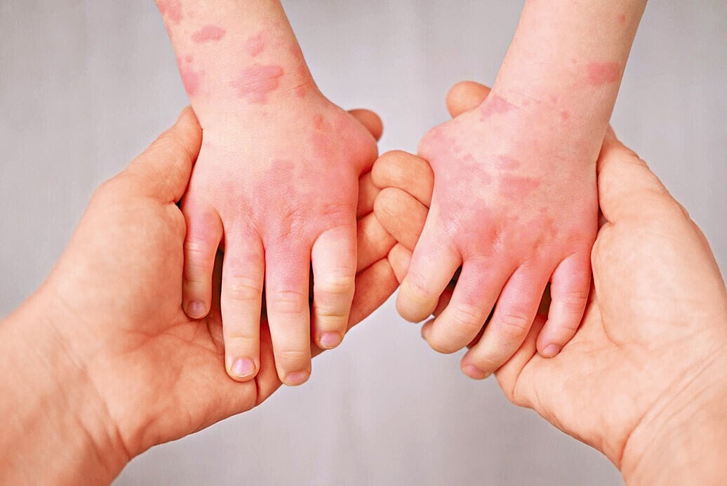 Health 3col What is a Food Allergy scaled