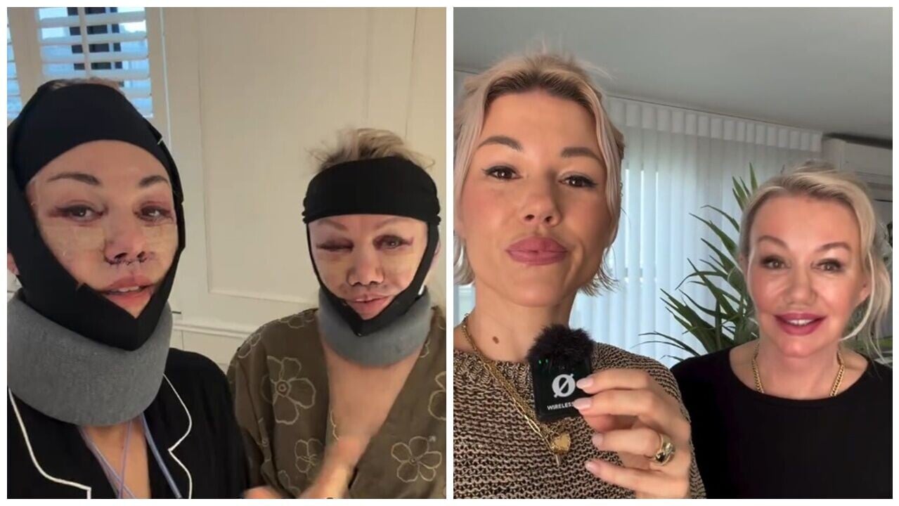 40歲女與69歲媽赴韓旅行變整容，拉皮後大方公開效果。(IG)