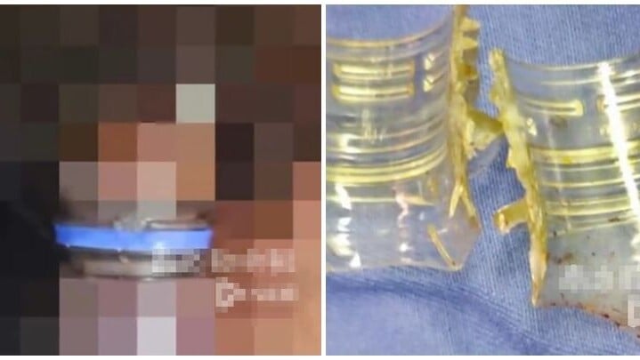 浙江省杭州市一名50歲男子「一時興起」將空可樂瓶套在自身隱私部位，數分鐘後下體迅速充血，可樂瓶口「卡住」軟組織，導致其折騰兩小時自救未果，前端更水腫發紫，最終在家人陪同下尷尬就醫。（微信視頻號@南方都市報）