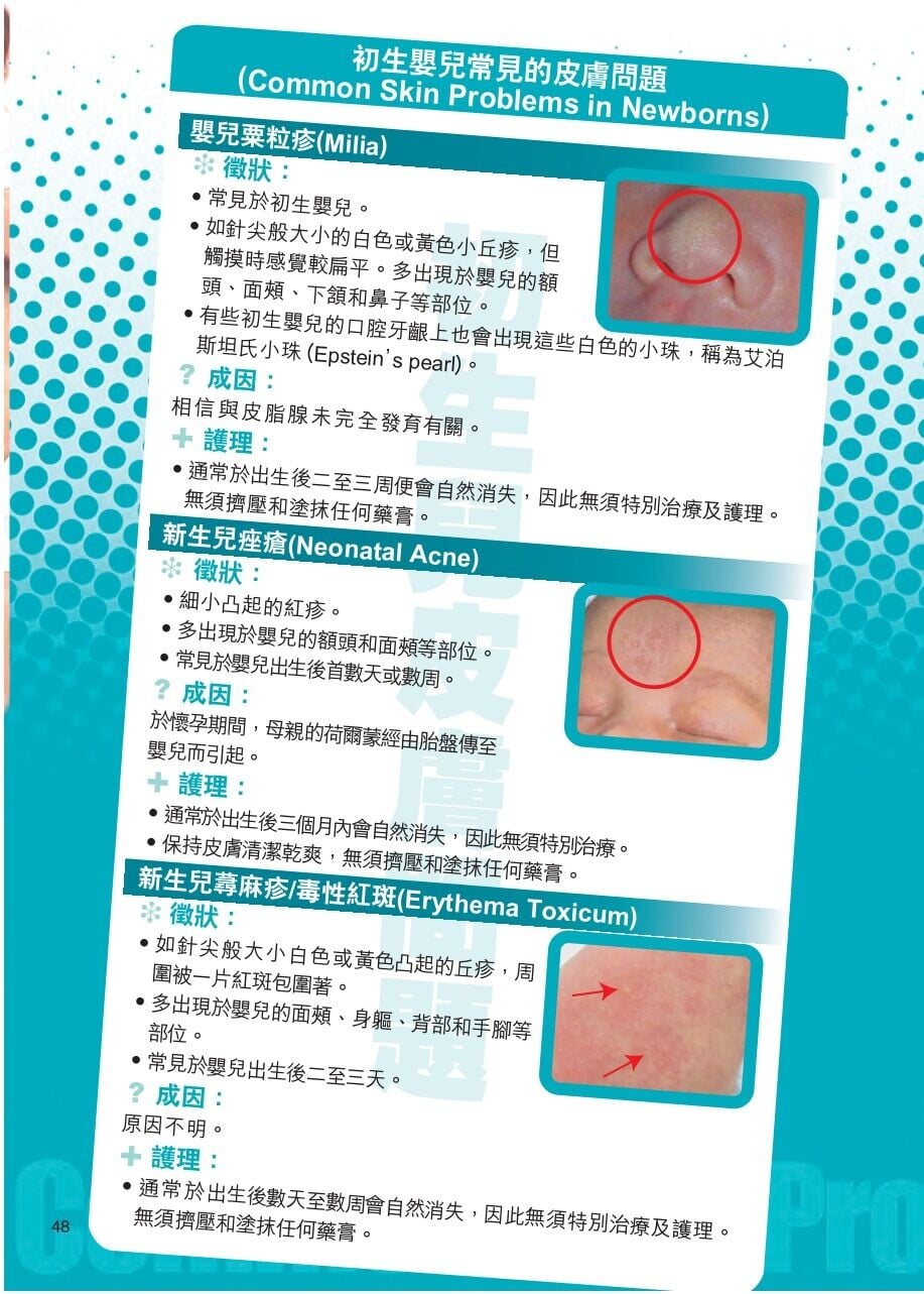 常見嬰兒皮膚問題,包括嬰兒粟粒疹、新生兒痤瘡、新生兒痤瘡(衛生署)