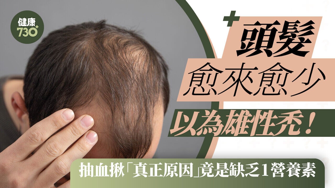頭髮愈來愈少以為雄性禿！抽血揪「真正原因」 竟是缺乏1營養素