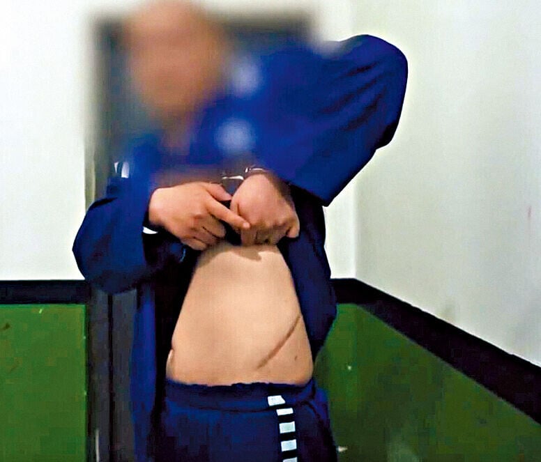 唐某豐拉起上衣露出「賣腎抵債」的疤痕。(互聯網)