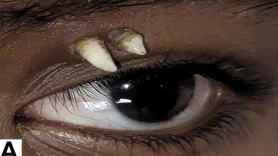 16歲少年眼皮長出兩「尖角」，CT檢查揭竟是牙齒。(Ophthalmology)