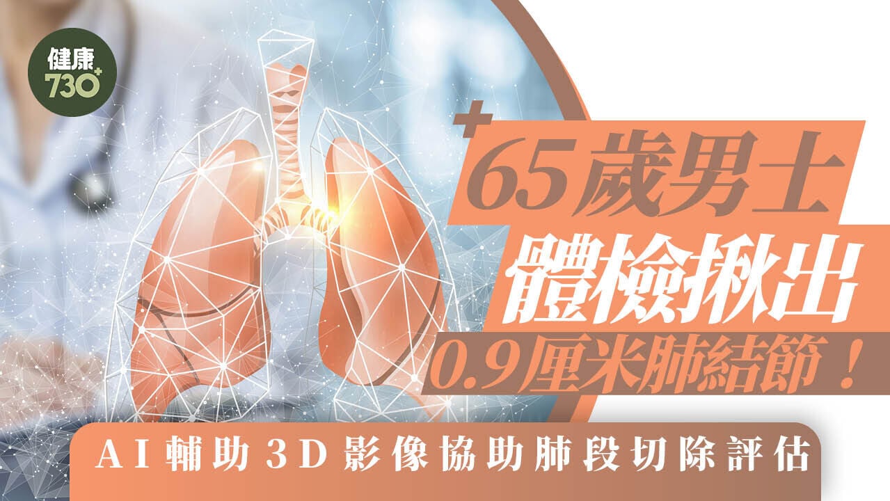 65歲男士體檢揪出0.9厘米肺結節！AI輔助3D影像協助肺段切除評估