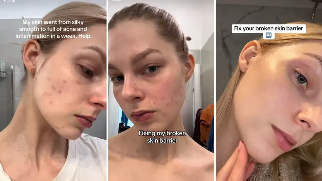 29歲網紅Greta Costioli曾為玻璃肌,使用高達7層不同保濕化妝水,初時效果理想,但後來出現問題