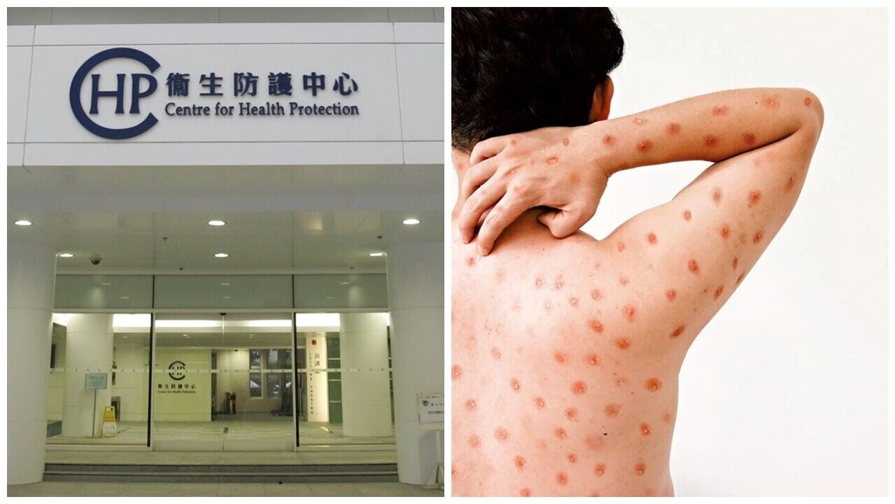 29歲男子確診猴痘，潛伏期曾與男性有高風險性接觸。