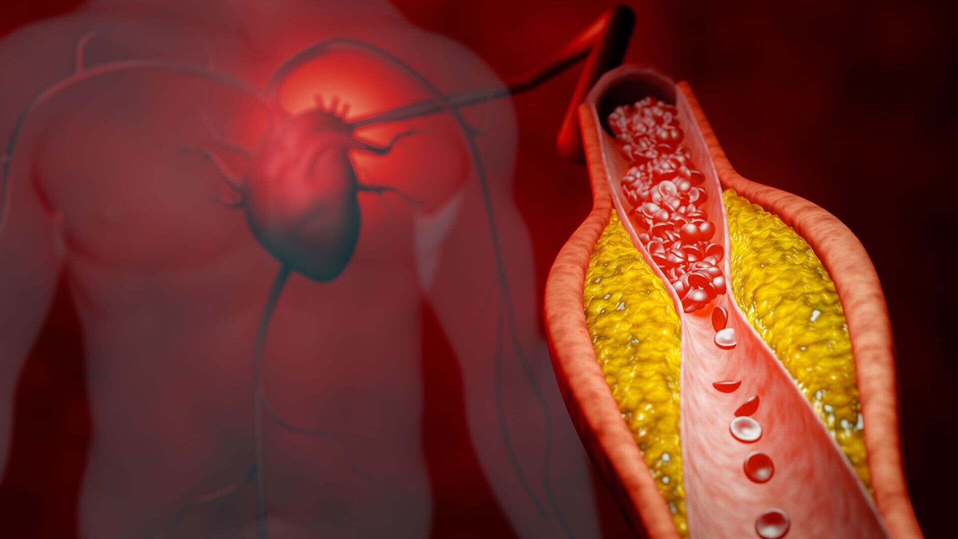中大研究：CD8⁺調節性T細胞成為動脈粥樣硬化治療新靶點