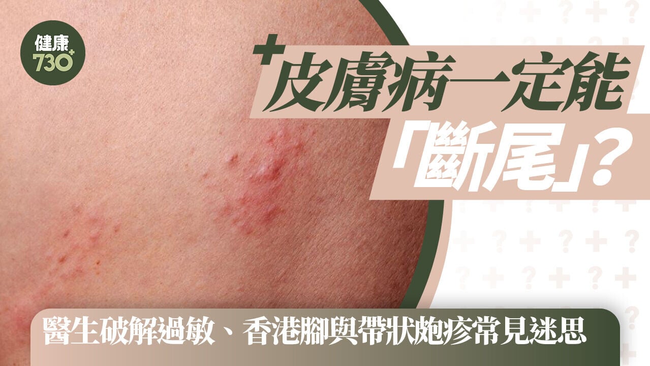 皮膚病一定能「斷尾」？醫生破解過敏、香港腳與帶狀皰疹常見迷思