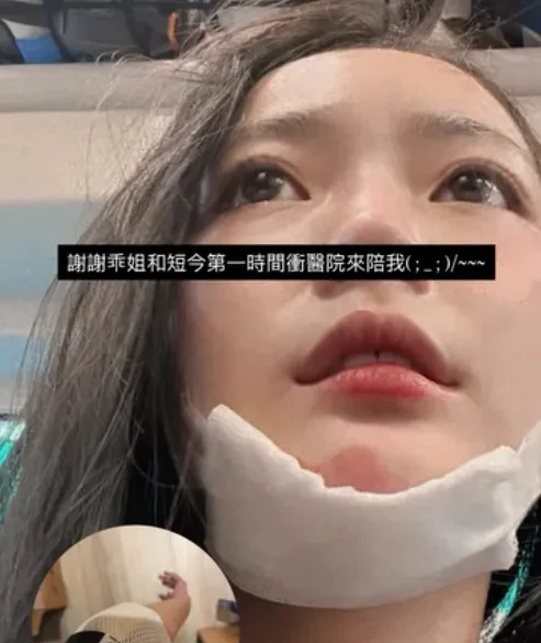 中信兄弟啦啦隊PS女孩怡琪因踩單車發生意外,導致下巴受傷需要縫針