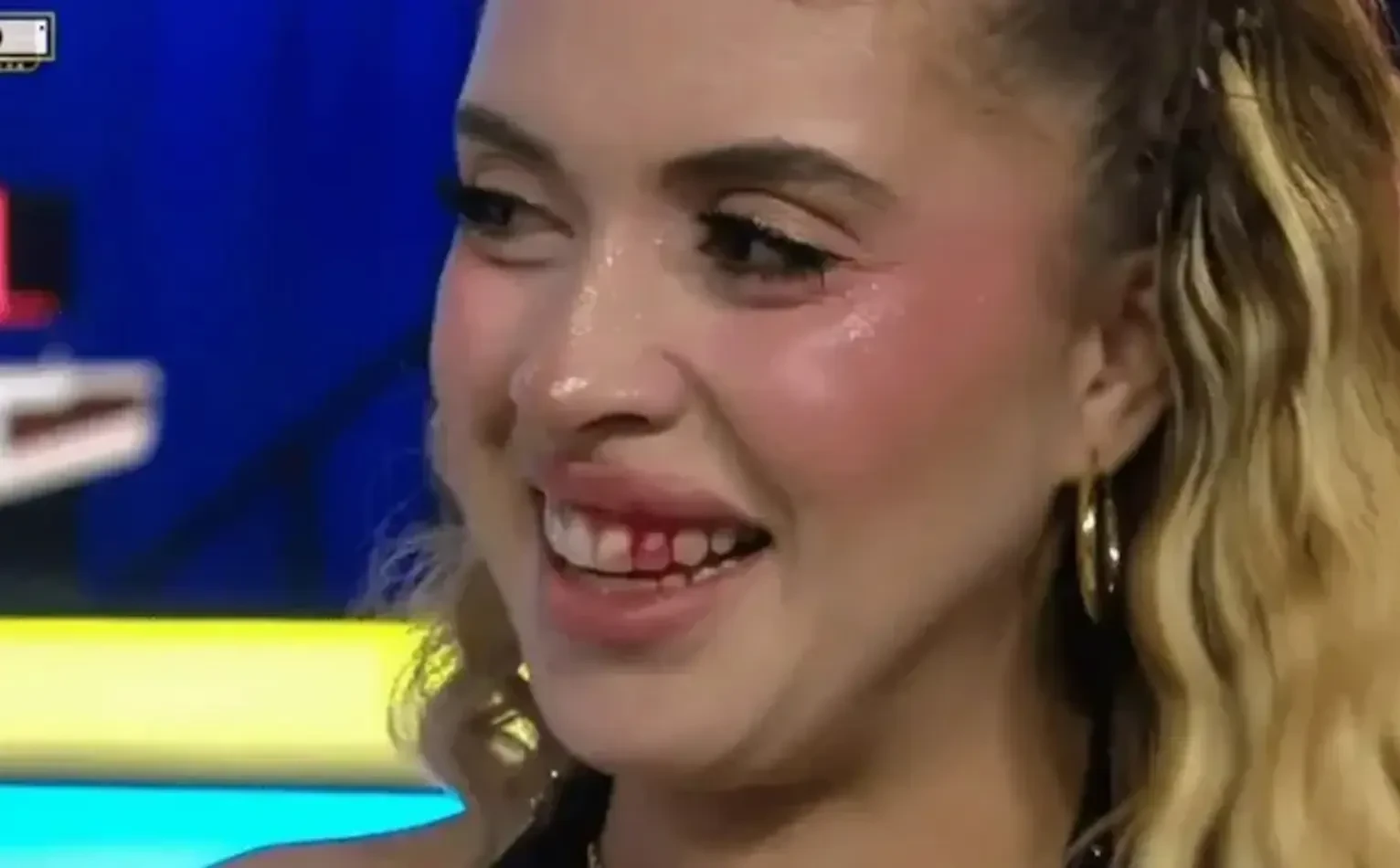 Isabella Rojas被航拍機所傷,嘴唇流血