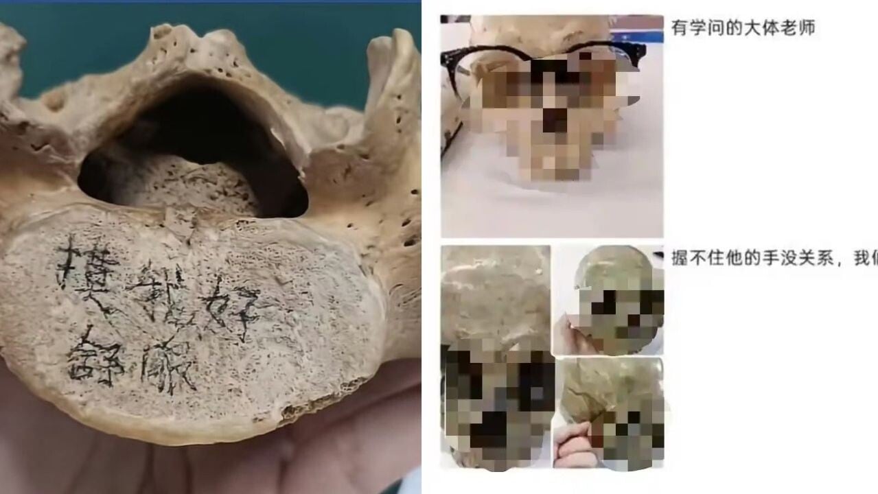 大體老師｜內地醫科生涉於骨頭上寫「死了骨頭還要被我玩」 被轟欠尊重