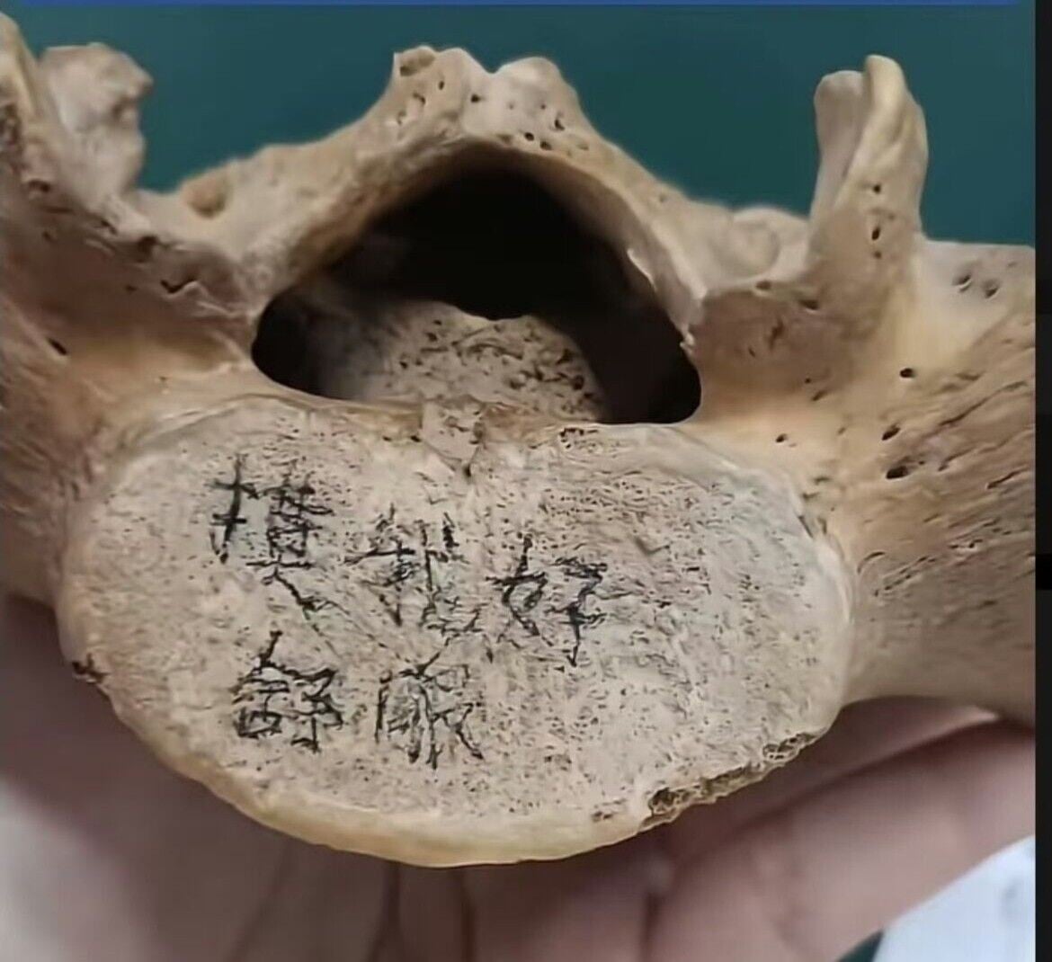 醫科生疑在骨頭上寫上「摸我很舒服」