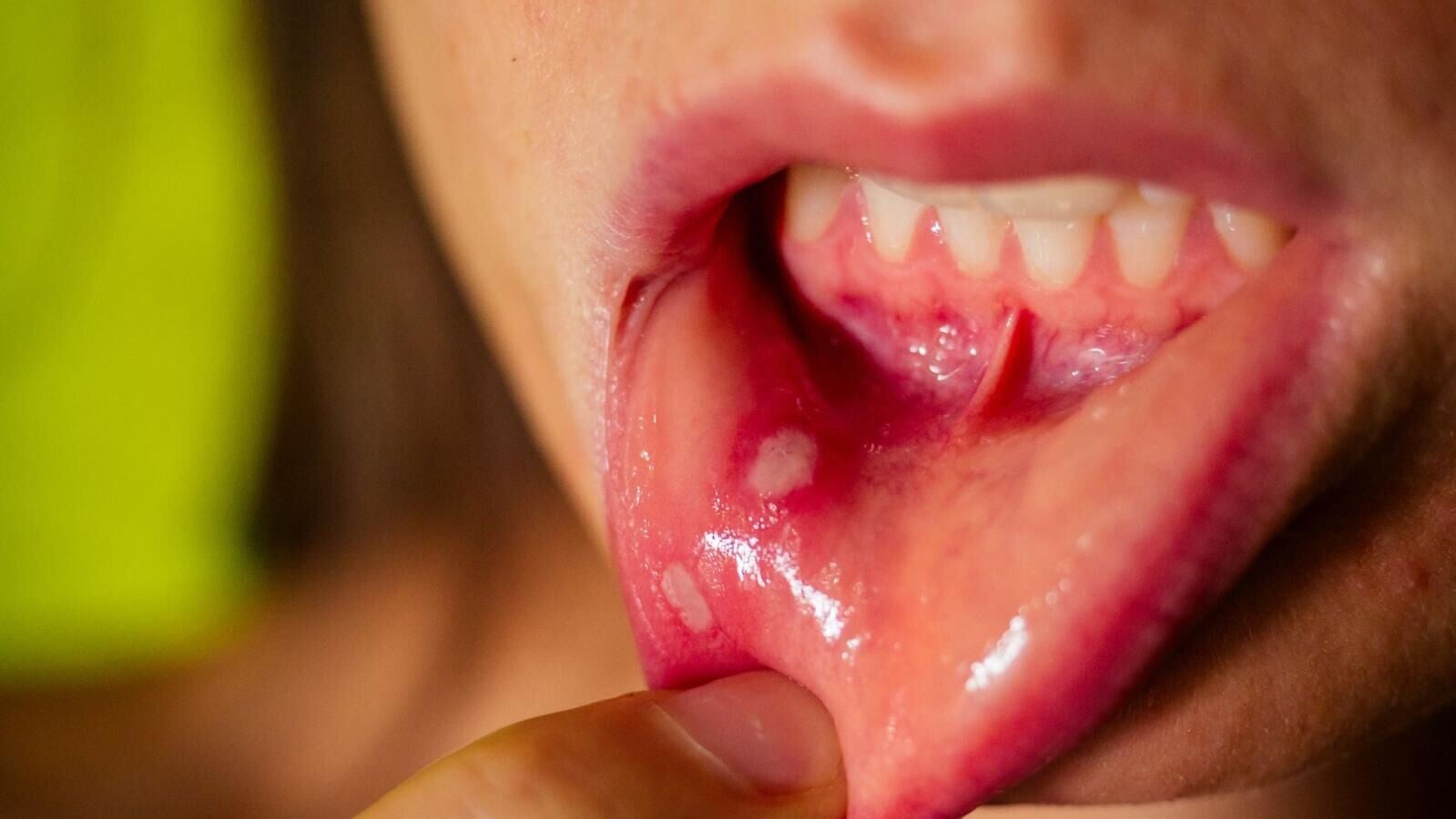 口腔健康小知識：生痱滋真係熱氣？拆解口腔潰瘍成因、白色假膜與紓緩方法