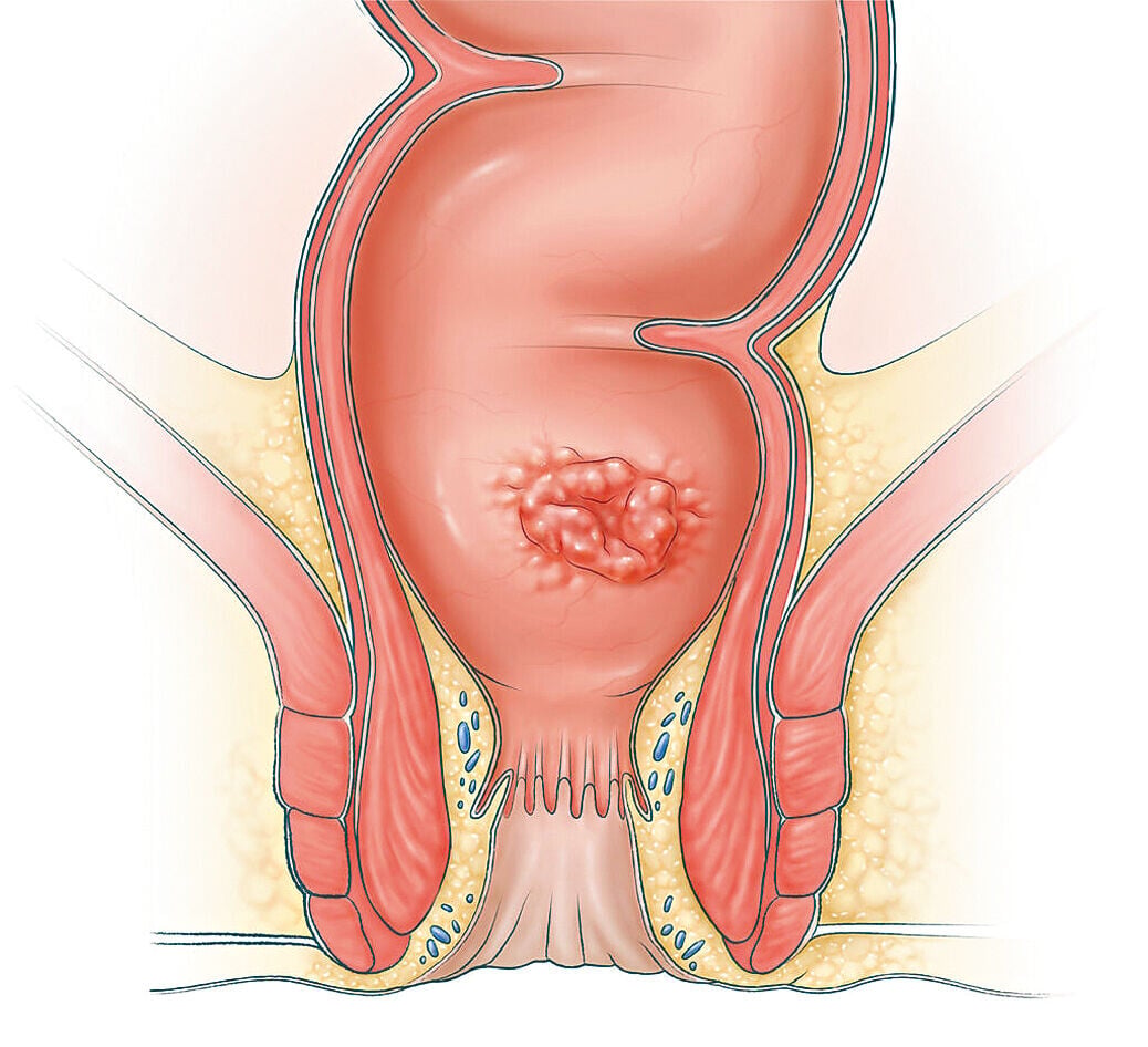 Health 3col kerectal cancer2 1024x932