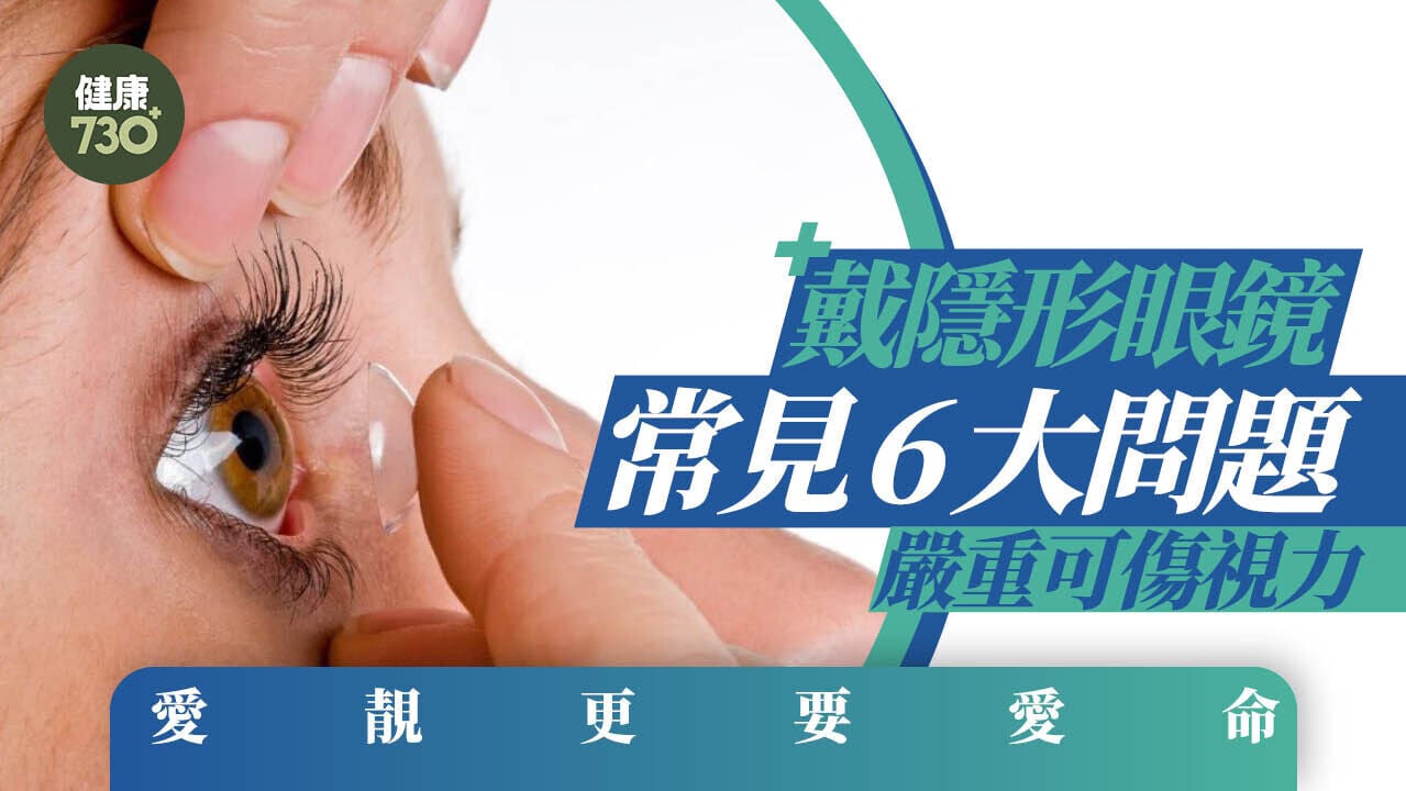隱形眼鏡或引致乾眼症、加劇角膜發炎6大問題 嚴重可傷視力