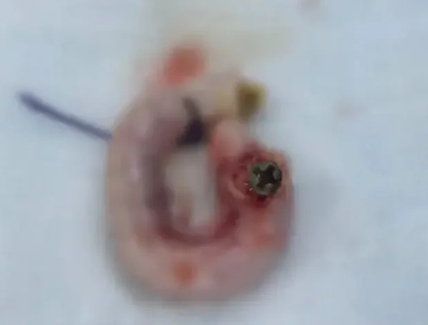 浙江8月大男嬰陰囊內驚現螺絲　醫生推測可能是誤食又疝氣肇禍