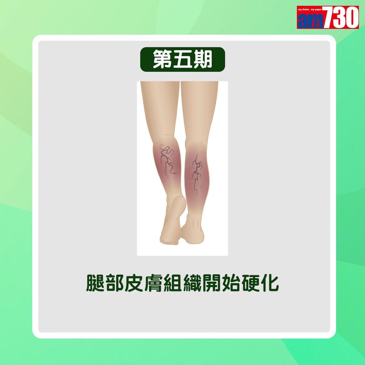 靜脈曲張病情分6個階段(am730製圖)