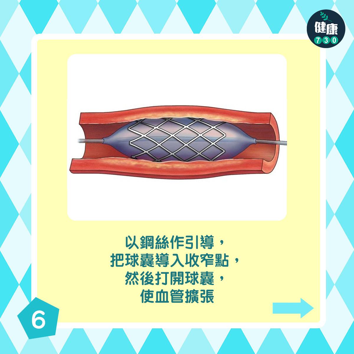 通波仔手術過程|以鋼絲作引導,把球囊導入收窄點,然後打開球囊,使血管擴張