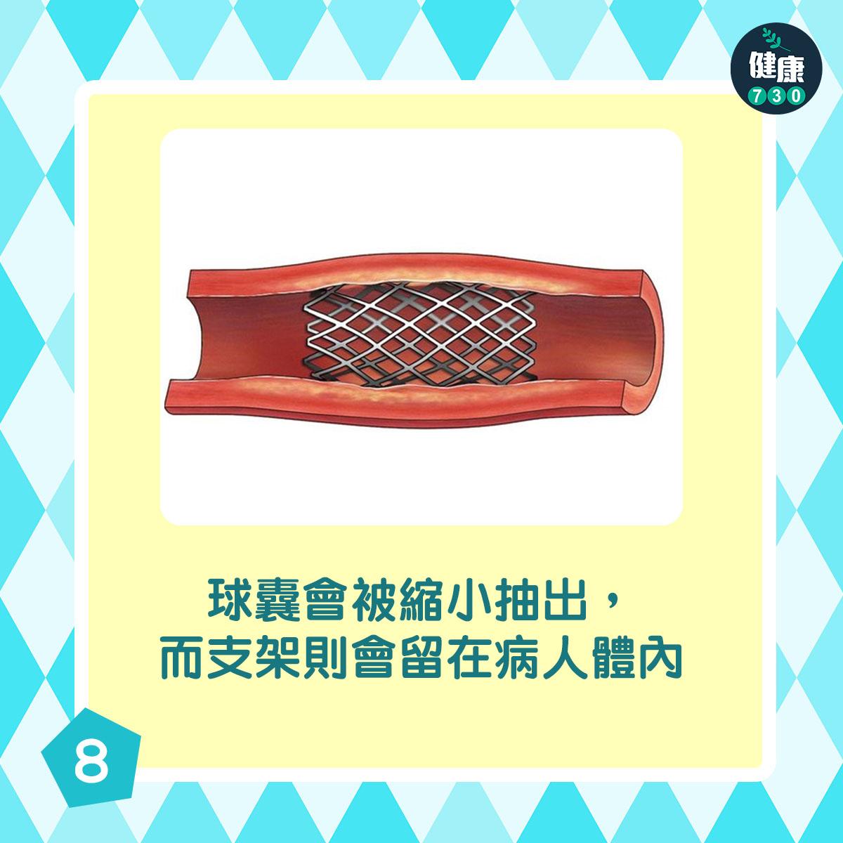 通波仔手術過程|球囊會被縮小抽出,而支架則會留在病人體內