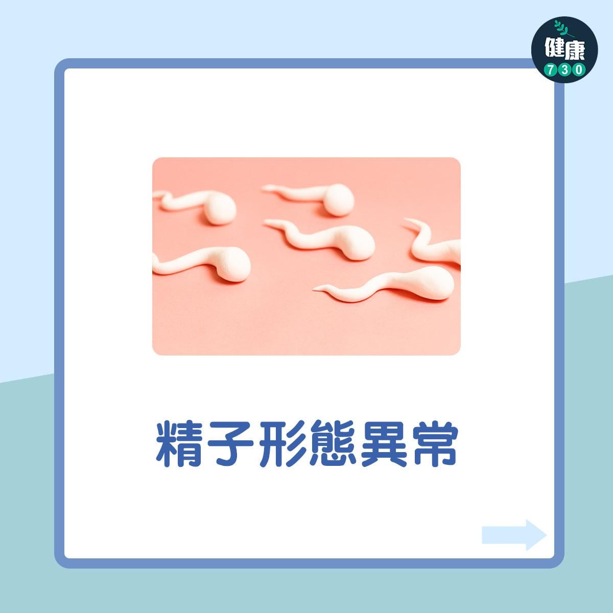男性不育7大原因︰精子形態異常(am730製圖)