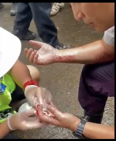 張建聲親身上陣拍爬牆戲受傷,工作人員治理傷口。