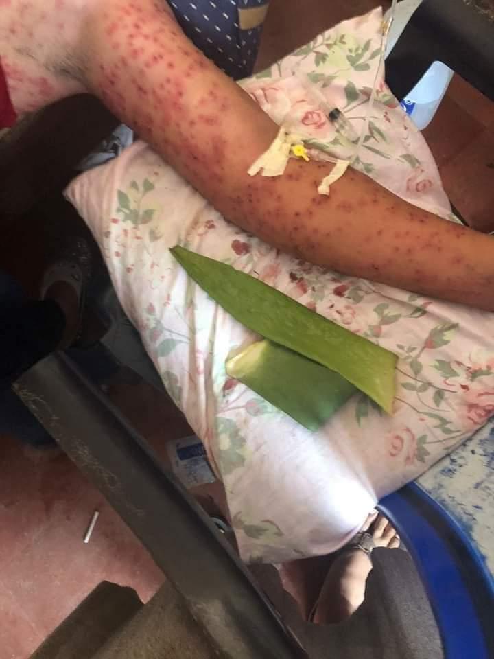 據當地傳媒相片可見,死傷者幾乎全身佈滿密密麻麻被蜂螫傷的紅色點。(Twitter)