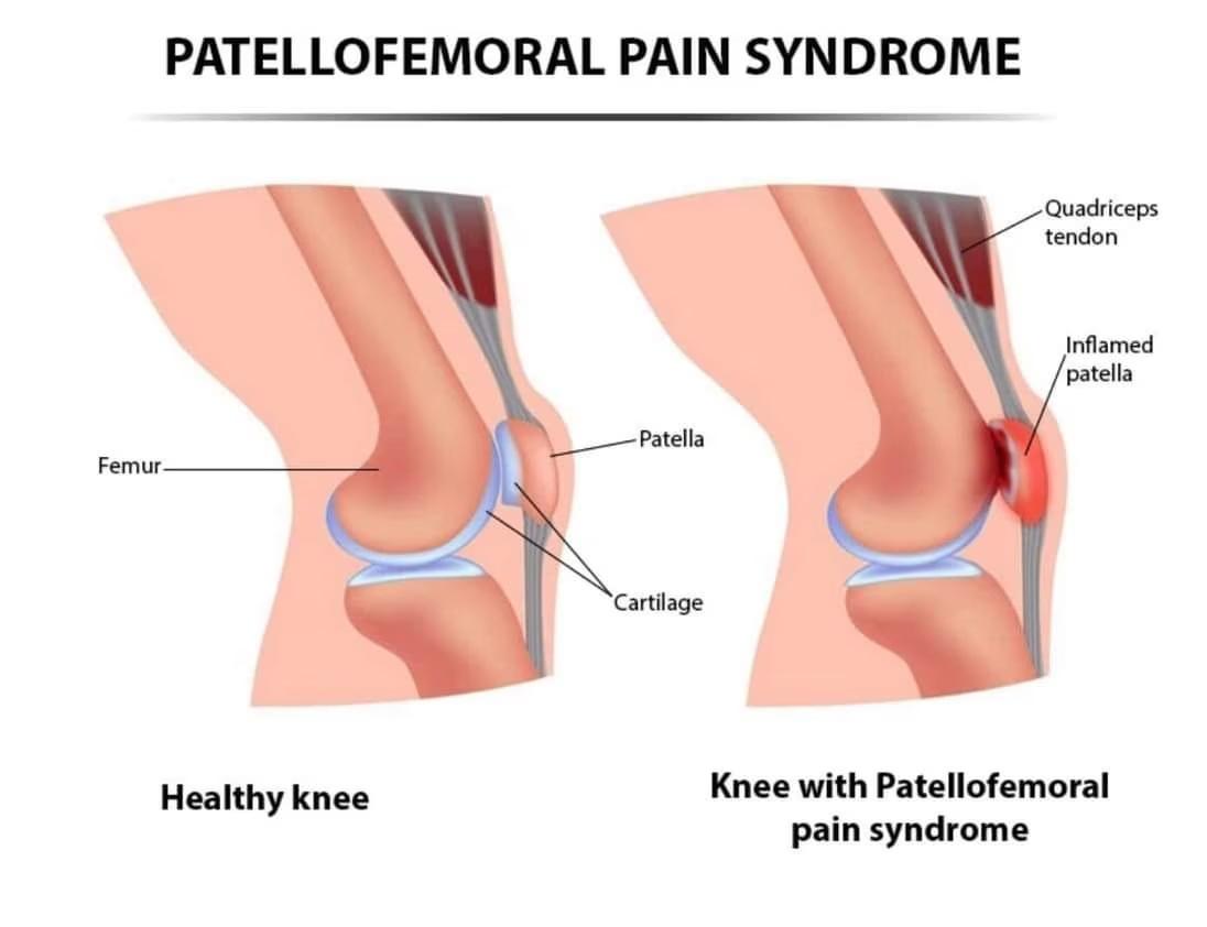 臏股關節綜合症