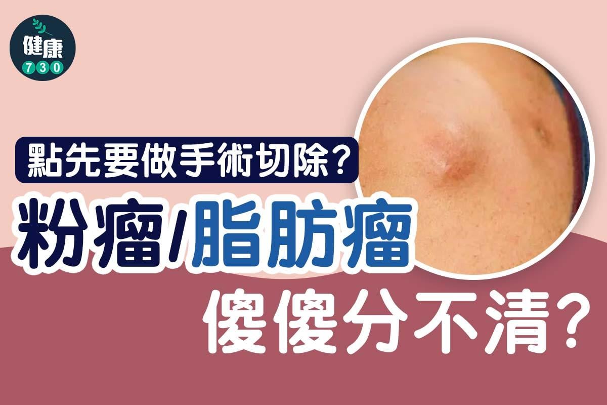 粉瘤與脂肪瘤分別,手術切除與否評估(am730製圖)