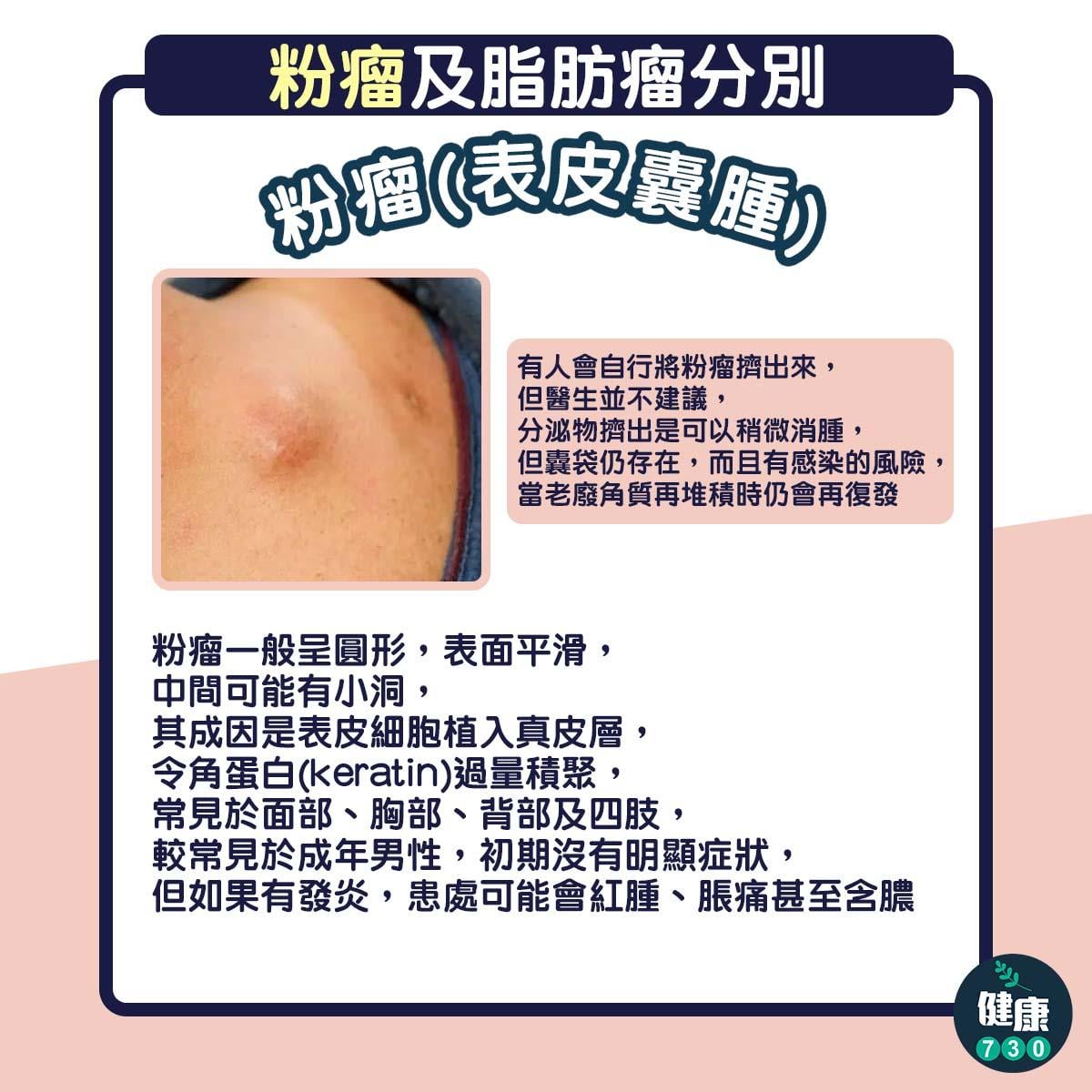 粉瘤與脂肪瘤分別,手術切除與否評估(am730製圖)