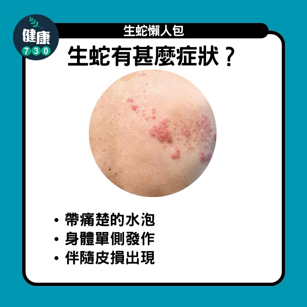 生蛇懶人包,生蛇有甚麼症狀(am730製圖)