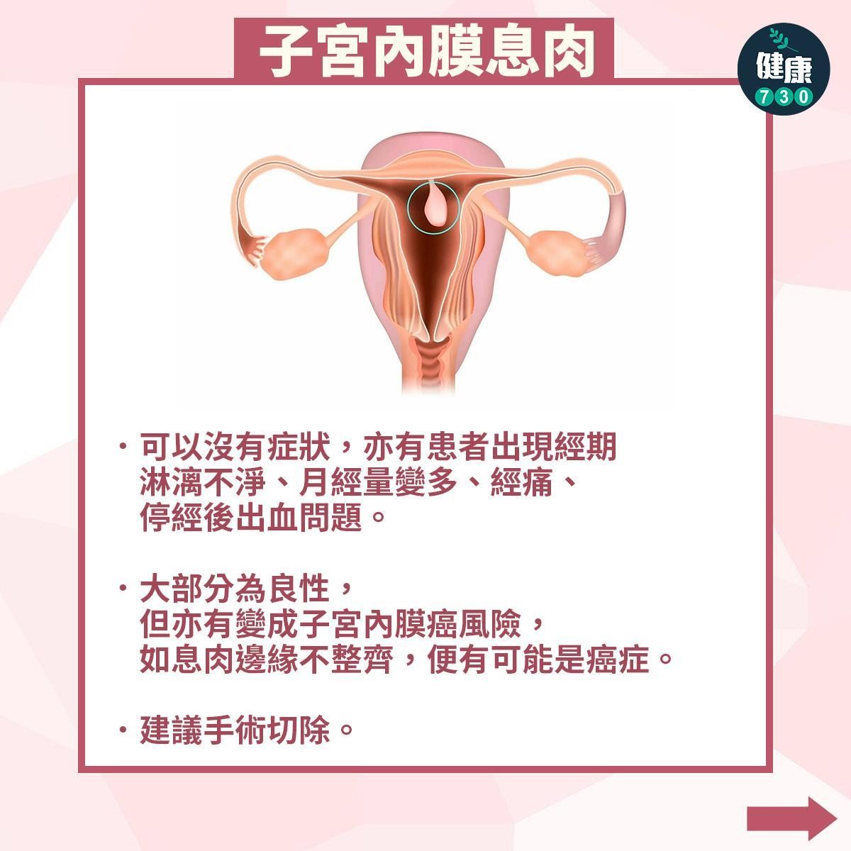 常見婦科疾病|子宮內膜息肉(am730製圖)