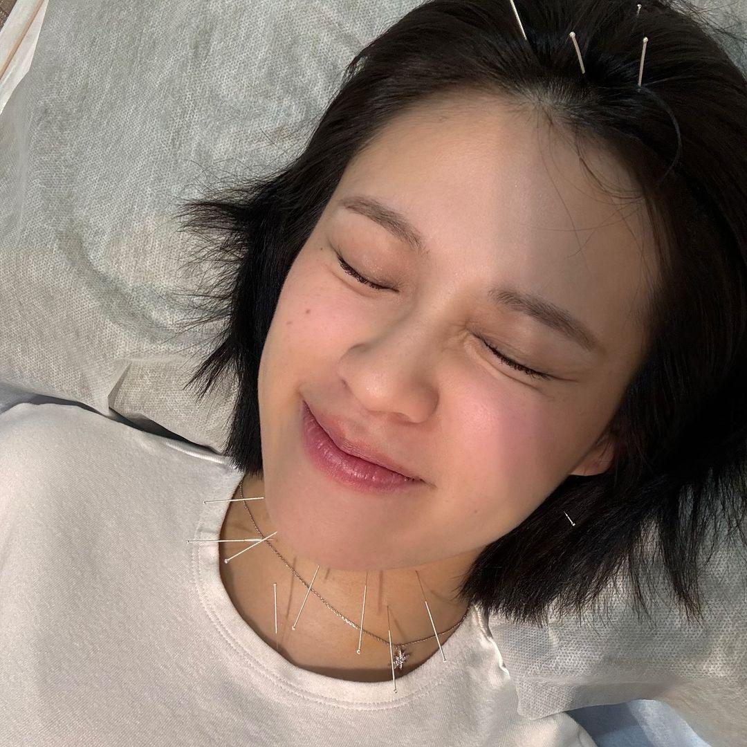 Winka在開騷前幾乎失聲，靠針灸紓緩。