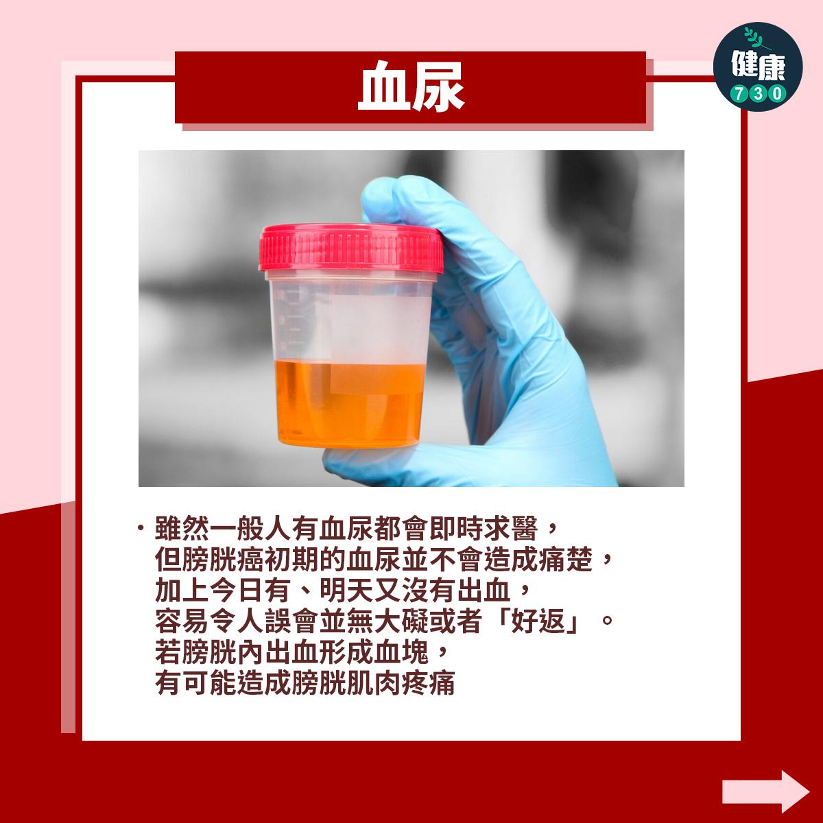 膀胱癌症狀|血尿(am730製圖)